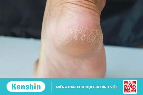 3 Cách trị nứt gót chân tại nhà đơn giản, hiệu quả 3