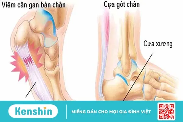 3 loại thuốc đặc trị viêm cân gan chân. Làm sao để phòng tránh biến chứng viêm cân gan chân? 1