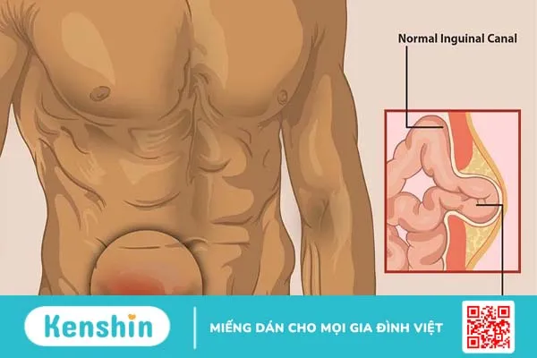 5 nguyên nhân đau bụng dưới bên phải thường gặp 3