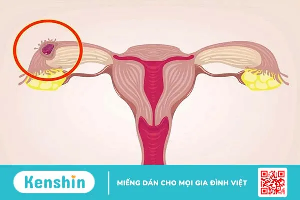 5 nguyên nhân đau bụng dưới bên phải thường gặp 4