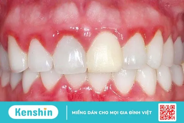 6 bệnh răng miệng thường gặp 2