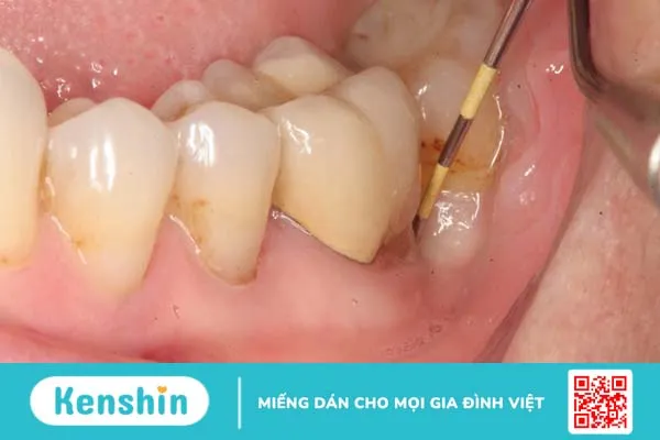 6 bệnh răng miệng thường gặp 3