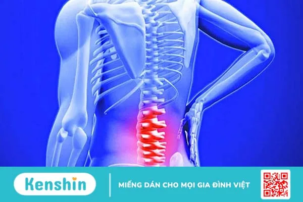 Nhiễm trùng cột sống là một trong những nguyên nhân gây áp xe ngoài màng cứng