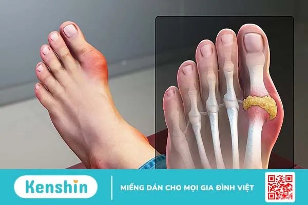 Arthritis là gì? Phòng tránh và điều trị 1