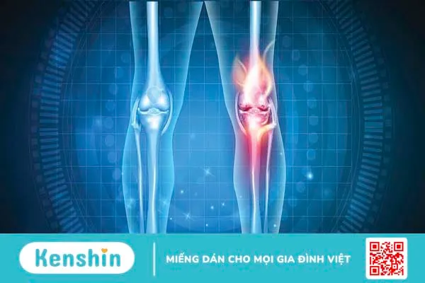 Arthritis là gì? Phòng tránh và điều trị 2