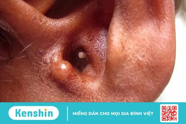 Ấu trùng ruồi maggot gây bệnh gì? Nguyên nhân, triệu chứng, chẩn đoán và cách điều trị bệnh