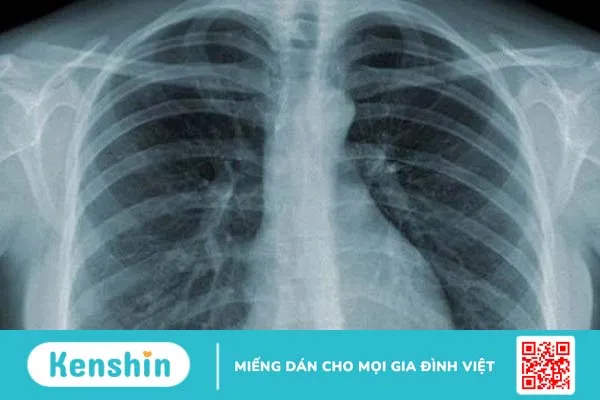 Ấu trùng ruồi maggot gây bệnh gì? Nguyên nhân, triệu chứng, chẩn đoán và cách điều trị bệnh