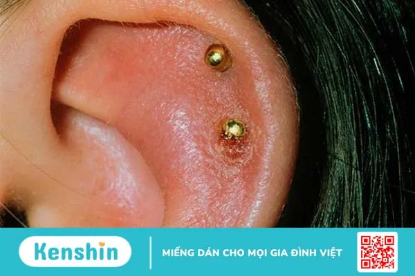 Bấm lỗ tai bị sưng mủ chảy máu - Giải quyết thế nào? 1