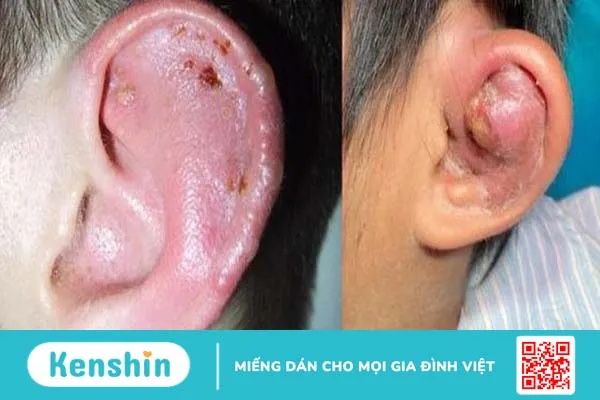 Bấm lỗ tai bị sưng mủ chảy máu - Giải quyết thế nào? 2