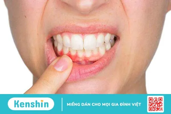 Bạn có muốn biết cách đánh răng không bị tụt lợi hay không?1