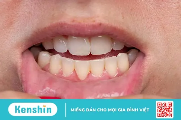 Bạn có muốn biết cách đánh răng không bị tụt lợi hay không?2