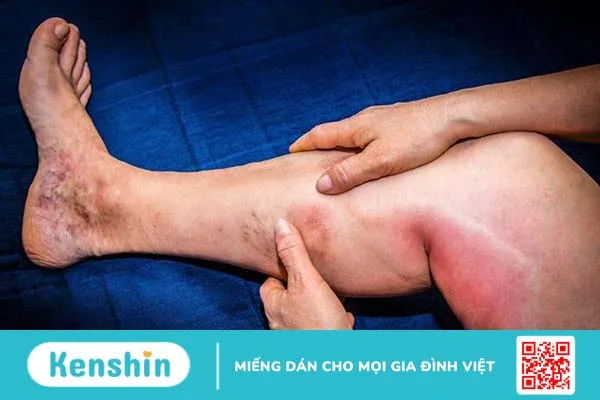 Bắp chân có cảm giác nóng là dấu hiệu của bệnh gì 2