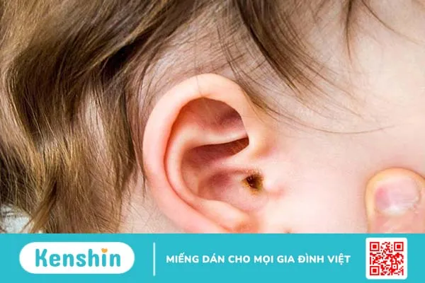 Bật mí các cách chữa viêm tai giữa bằng lá mơ lông hiệu quả 1