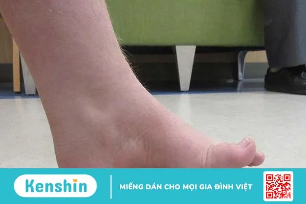 Bệnh Charcot-Marie-Tooth là bệnh gì? 1