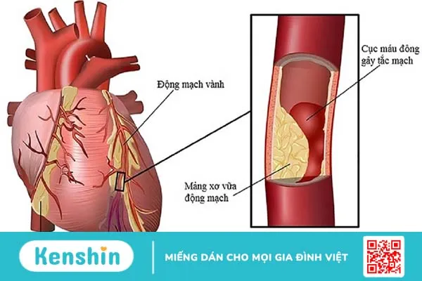 Bệnh co thắt động mạch vành: Dấu hiệu nhận biết, biến chứng và cách điều trị 2