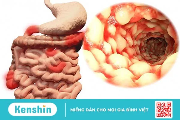 Bệnh Crohn của đại tràng là một bệnh mãn tính nên không thể chữa khỏi hoàn toàn