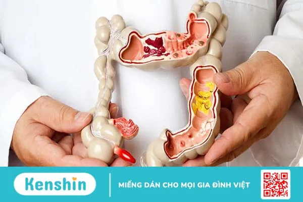 Bệnh Crohn ở trẻ em là một bệnh viêm ruột mãn tính