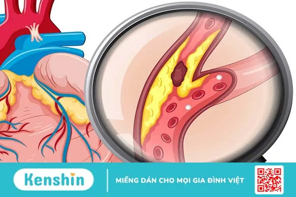 Bệnh động mạch chủ: Biểu hiện, điều trị và biện pháp phòng ngừa 1