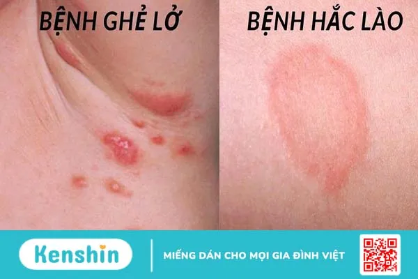 Bệnh ghẻ lở hắc lào là gì? Cách phân biệt ghẻ lở và hắc lào 1