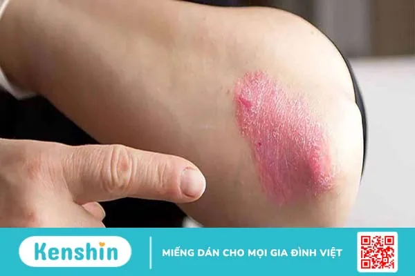 Bệnh ghẻ lở hắc lào là gì? Cách phân biệt ghẻ lở và hắc lào 2