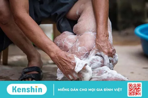 Bệnh giun chỉ bạch huyết: Triệu chứng, nguyên nhân và cách phòng ngừa 1