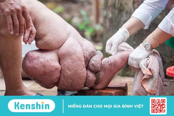 Bệnh giun chỉ bạch huyết: Triệu chứng, nguyên nhân và cách phòng ngừa 2