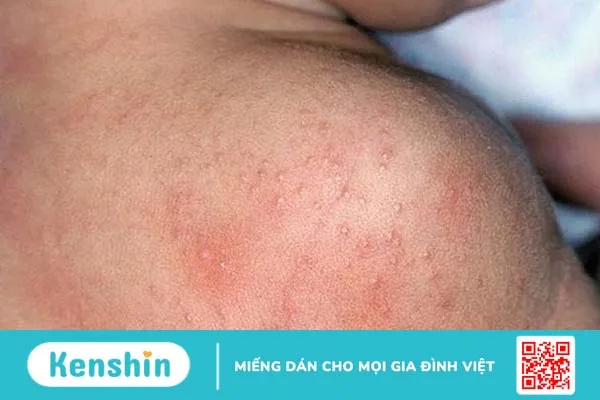 Bệnh Herpangina: Đường lây truyền, triệu chứng, chẩn đoán, điều trị 3