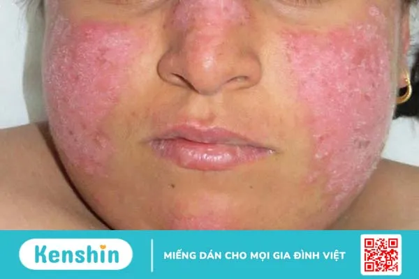 Bệnh lupus ban đỏ có di truyền không?