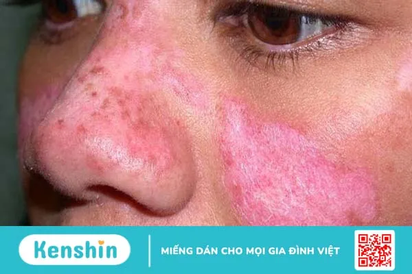 Bệnh lupus ban đỏ có di truyền không? 2