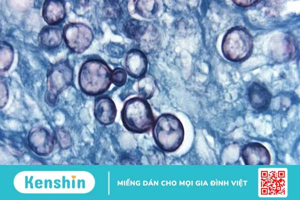 Bệnh nấm Histoplasmosis là bệnh gì? Triệu chứng và phương pháp điều trị