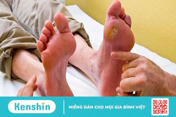 Bệnh nấm Histoplasmosis là bệnh gì? Triệu chứng và phương pháp điều trị