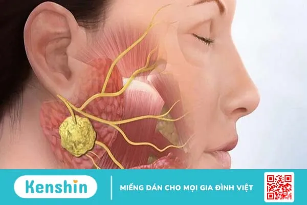 Bệnh quai bị có nổi hạch không? 1