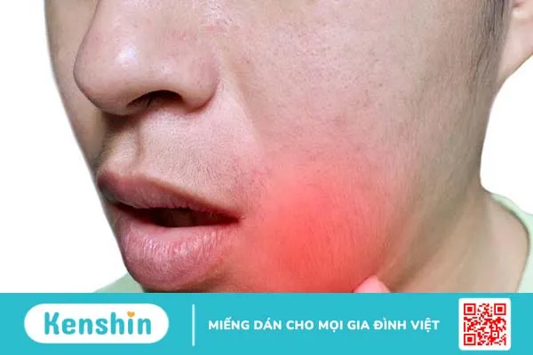 Bệnh quai bị có nổi hạch không? 2