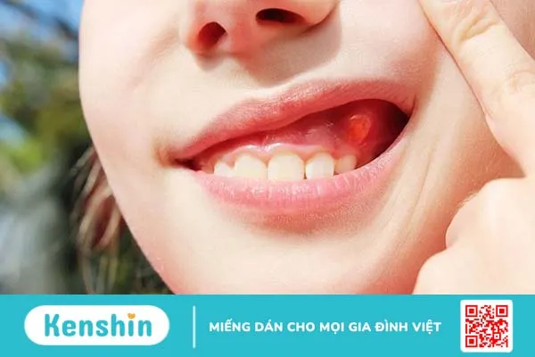 Bệnh răng miệng ở trẻ em: Nguyên nhân và cách điều trị 2