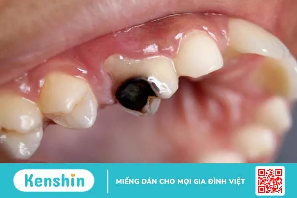 Bệnh răng miệng ở trẻ em: Nguyên nhân và cách điều trị 3