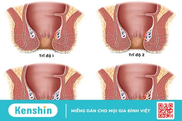 Bệnh trĩ cấp độ 3 có nguy hiểm không? Các dấu hiệu nhận biết 1