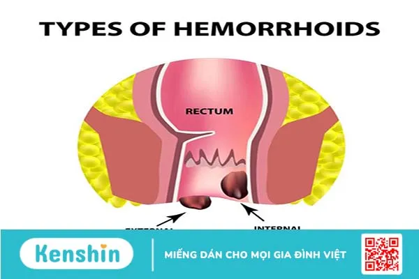 Bệnh trĩ có ảnh hưởng đến sinh sản không? Ảnh hưởng như thế nào 1