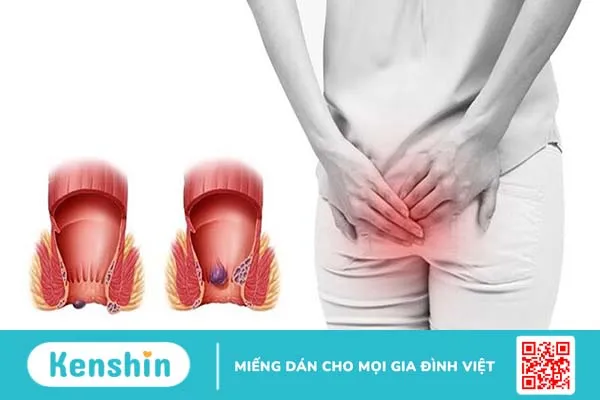 Bệnh trĩ gây nên khị các tĩnh mạch ở vùng hậu môn bị tổn thương