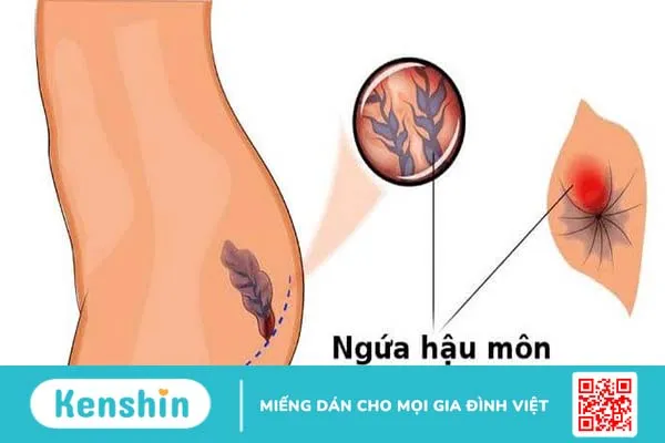 Bệnh trĩ có tự khỏi được không 1