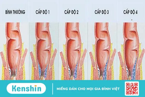 Bệnh trĩ có tự khỏi được không 2