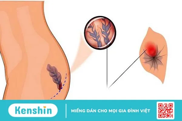 Bệnh trĩ độ 1 là như thế nào? Nguyên nhân bệnh trĩ là gì? 1