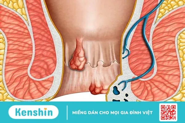 Bệnh trĩ độ 1 là như thế nào? Nguyên nhân bệnh trĩ là gì? 2