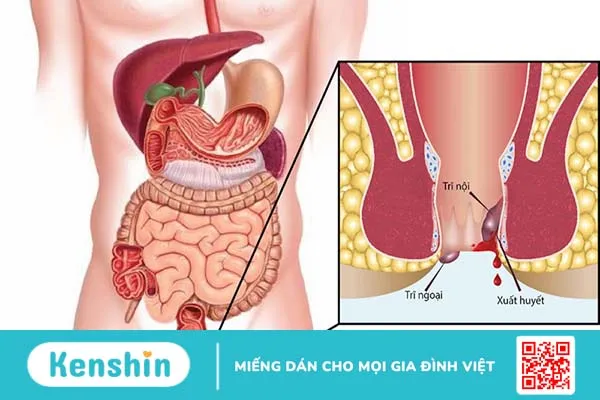 Bệnh trĩ độ 2 là gì? Các biểu hiệu chuyển biến thành bệnh trĩ độ 2 1