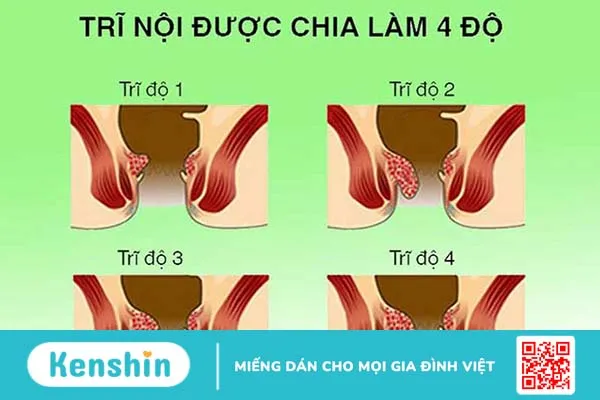 Bệnh trĩ là gì? 3 cách chữa trĩ hiệu quả tại nhà 1