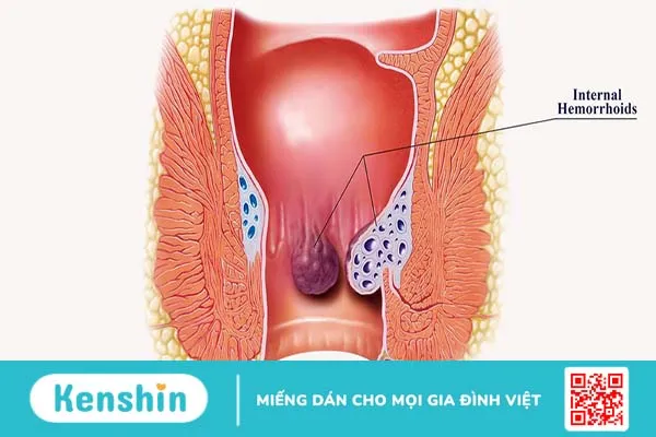 Bệnh trĩ là gì? Các phương pháp chữa bệnh trĩ nào an toàn và hiệu quả 1