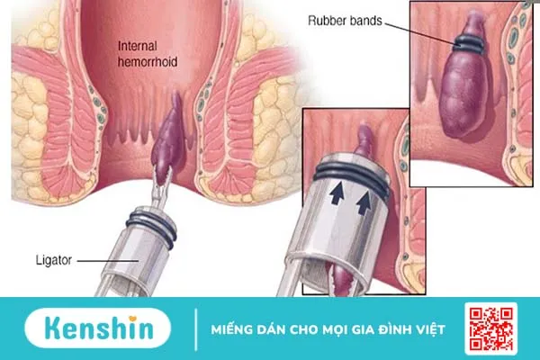 Bệnh trĩ là gì? Các phương pháp chữa bệnh trĩ nào an toàn và hiệu quả 2