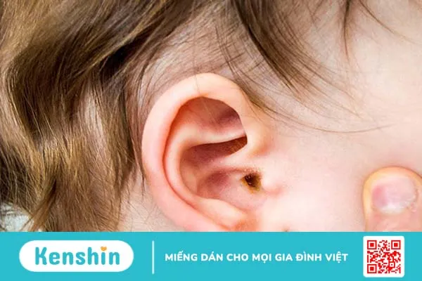 Viêm tai giữa có di truyền không?