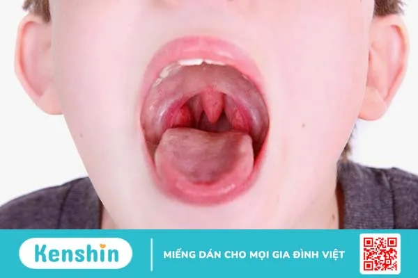 Bệnh viêm VA ở trẻ em có nguy hiểm không? 2