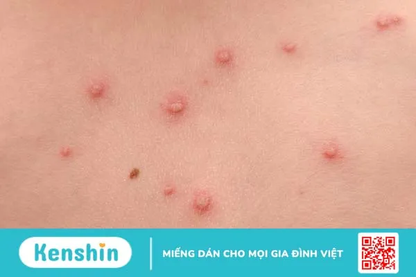 Bệnh zona thần kinh ở cổ là gì? Những thông tin cần biết 1