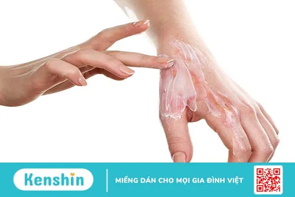 Bị bỏng bôi kem đánh răng có đúng không?